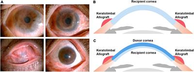 Outcome of keratolimbal allograft transplantation with deep anterior lamellar keratoplasty for bilateral limbal stem cell deficiency